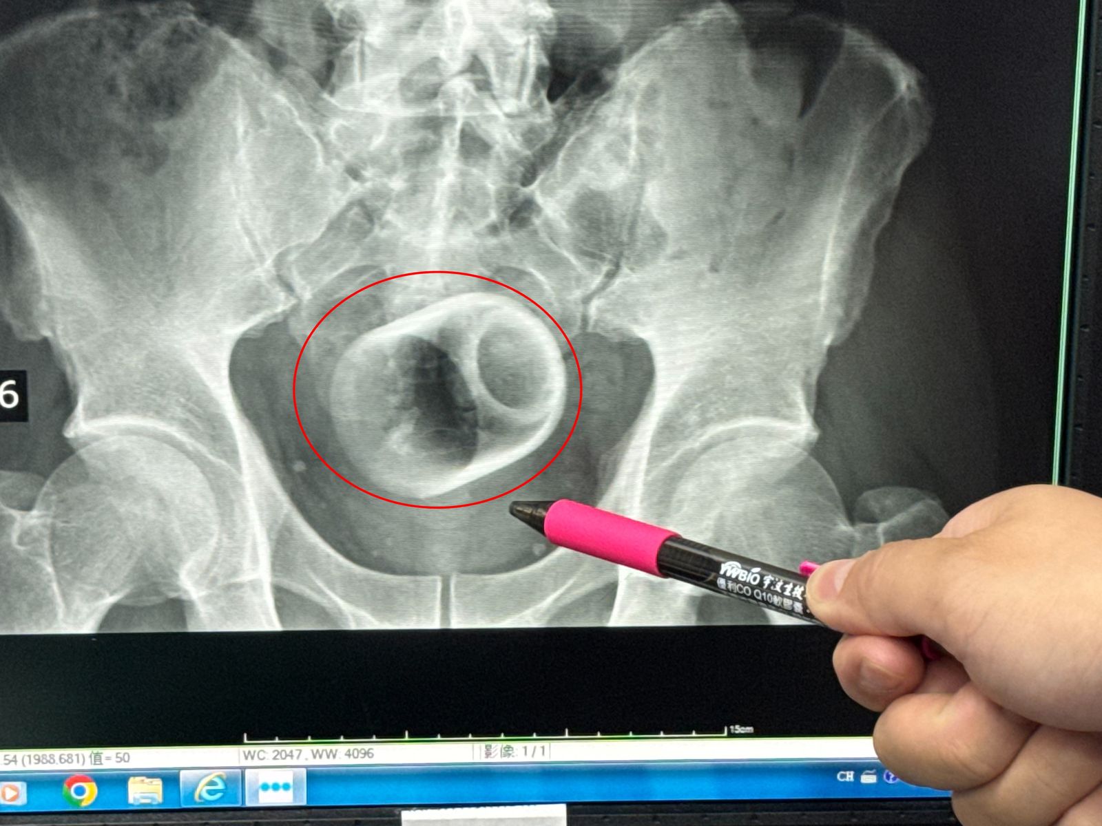 男子3天無法排便！醫檢查大驚：菊花裡...