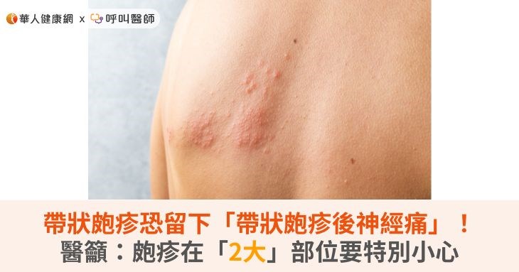 帶狀皰疹恐留下「帶狀皰疹後神經痛」！...