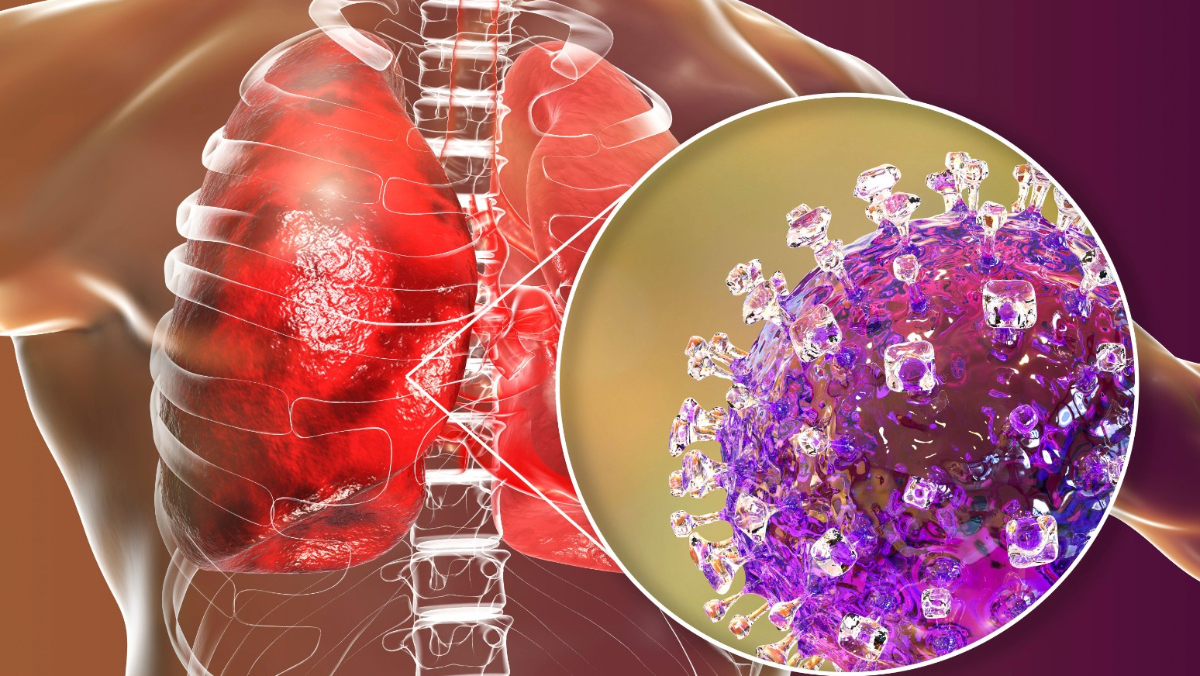 【一文看懂】致死率4成起跳！印度爆立百病毒疫情　這是什麼疾病？